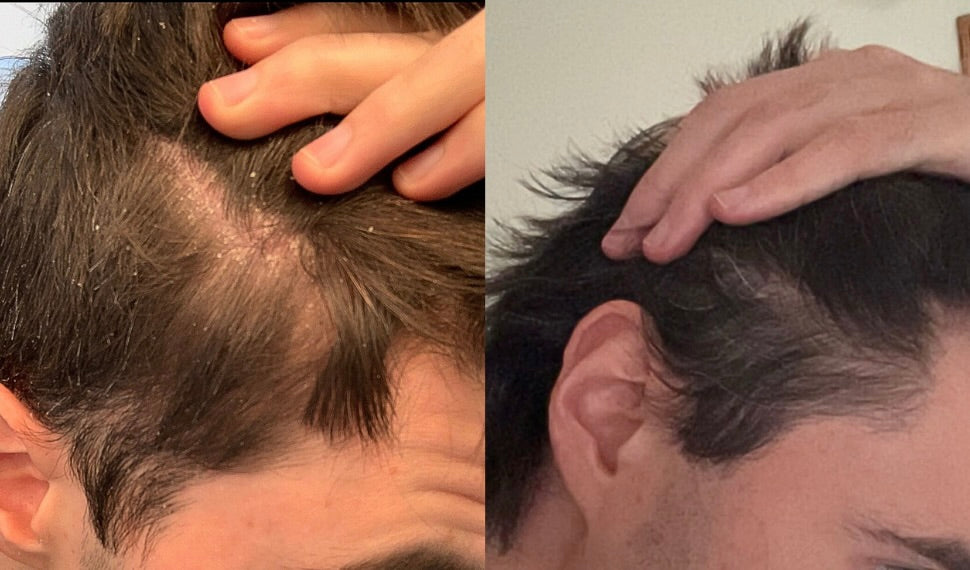 Side-by-side comparison of a person's dry irritated scalp with redness and flakes compared to scalp, with no flakes, no redness and stronger hair after using Happy Lad shampoo.